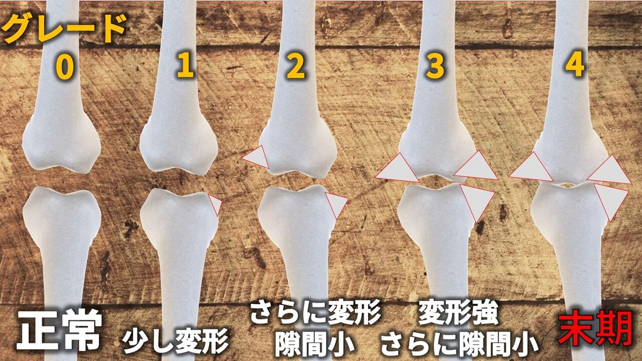 Kellgren-Laurence分類